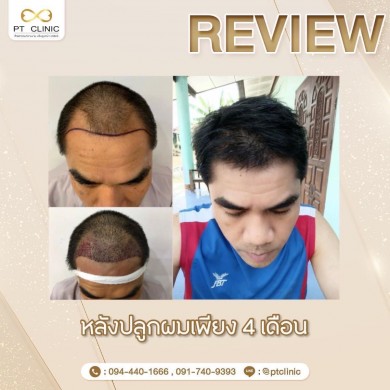 หลังปลูกผมเพียง 4 เดือน