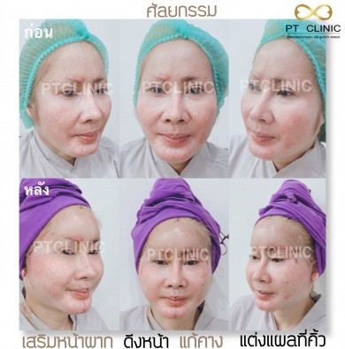 เสริมหน้าผาก ดึงหน้า แก้คาง แต่งแผลที่คิ้ว