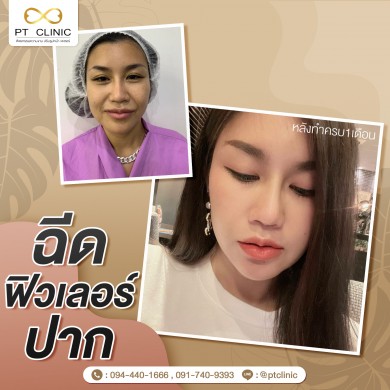 ฉีดฟิวเลอร์ปาก