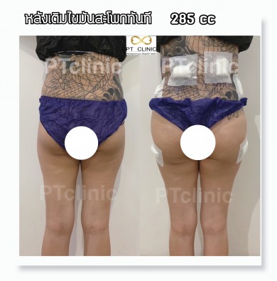 หลังเติมไขมันสะโพกทันที 285cc