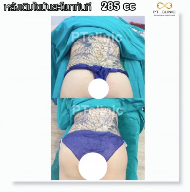 หลังเติมไขมันสะโพกทันที 285cc