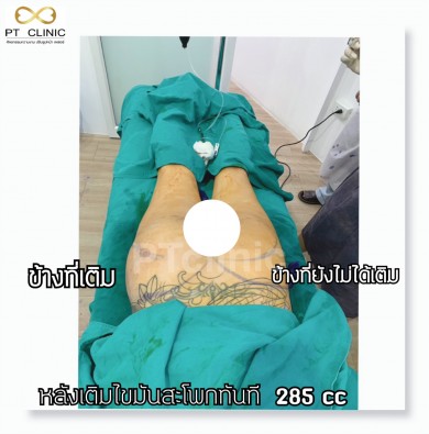 หลังเติมไขมันสะโพกทันที 285cc