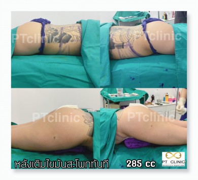 หลังเติมไขมันสะโพกทันที 285cc