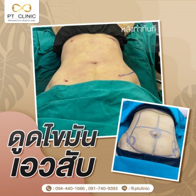 ดูดไขมันเอวสับ