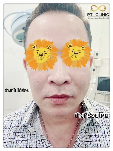 ร้อยไหม