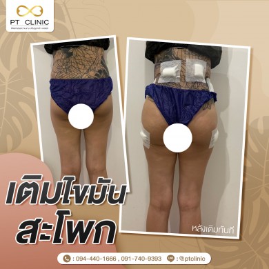 เติมไขันสะโพก