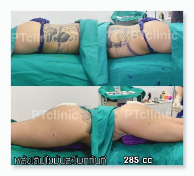 หลังเติมไขมันสะโพกทันที 285cc
