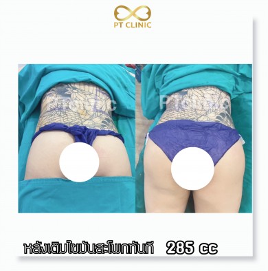 หลังเติมไขมันสะโพกทันที 285cc