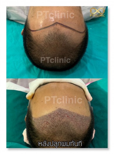 รีวิวปลูกผม