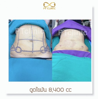 รีวิวดูดไขมัน