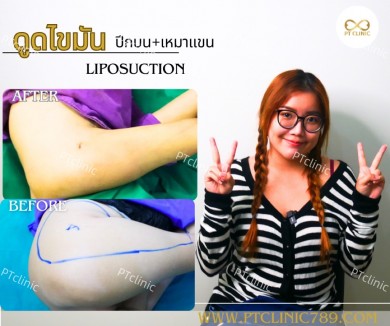 รีวิวดูดไขมัน