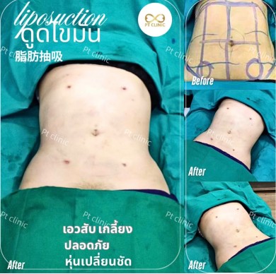 รีวิวดูดไขมัน