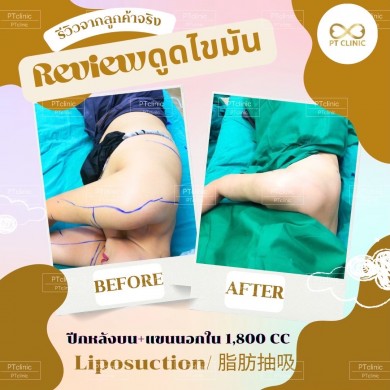 รีวิวดูดไขมัน