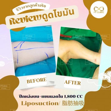 รีวิวดูดไขมัน