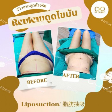 รีวิวดูดไขมัน
