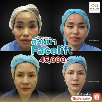โปรแกรมดึงหน้า Facelift